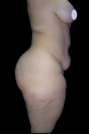 Lipo Hd, Doctor Luis Yesid Martínez Laguna