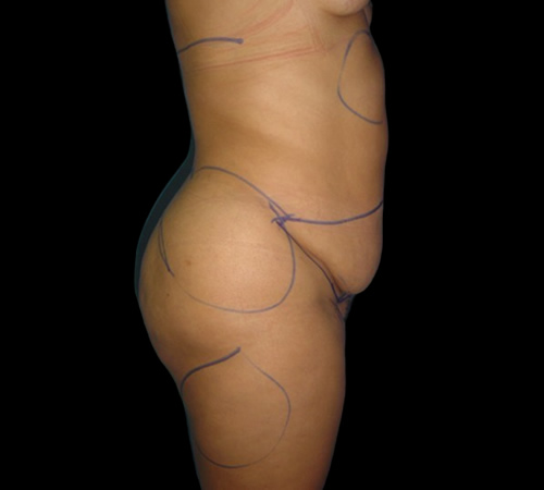 Gluteoplastia, Doctor Luis Yesid Martínez Laguna