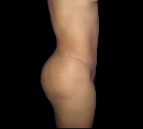 Gluteoplastia, Doctor Luis Yesid Martínez Laguna