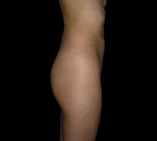 Gluteoplastia, Doctor Luis Yesid Martínez Laguna