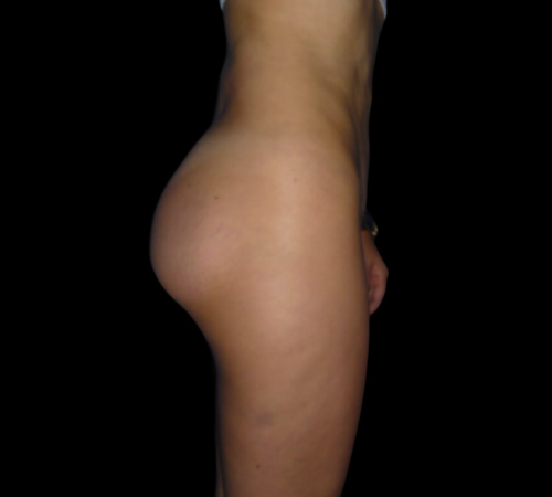 Gluteoplastia, Doctor Luis Yesid Martínez Laguna