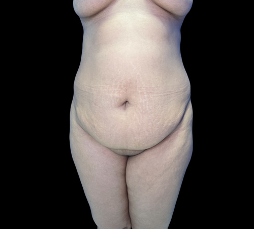 Lipoabdominoplastia, Doctor Luis Yesid Martínez Laguna