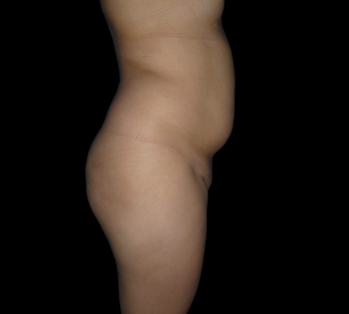 Gluteoplastia, Doctor Luis Yesid Martínez Laguna