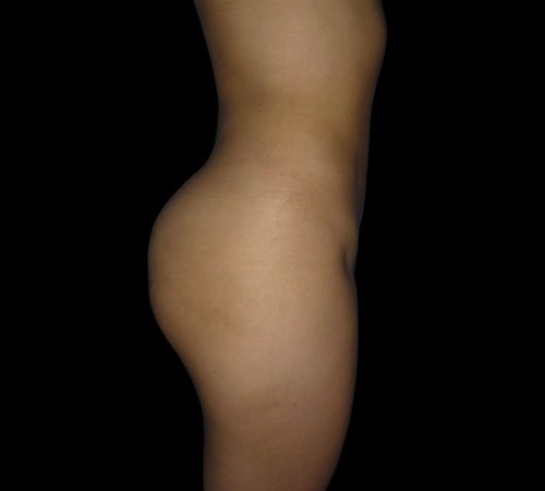 Gluteoplastia, Doctor Luis Yesid Martínez Laguna