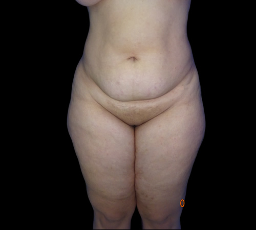 Lipoabdominoplastia, Doctor Luis Yesid Martínez Laguna